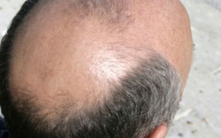 Пропеция (финастерид) – замечательный по эффективности и легкости использования препарат для лечения облысения волос у мужчин.