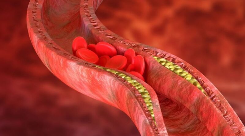 Ощущения при атеросклерозе периферических артерий