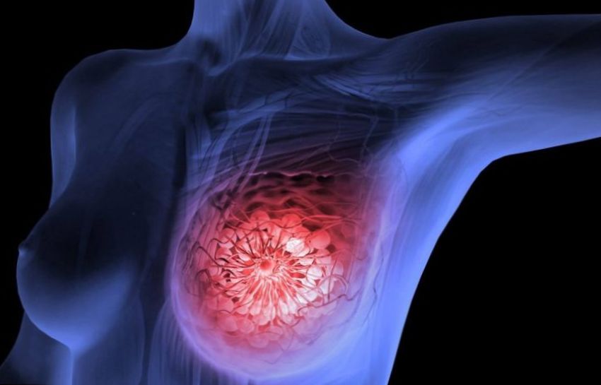 Что такое рак молочной железы?